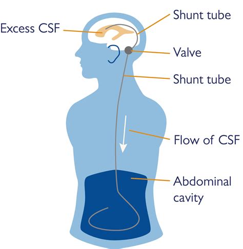 Hydrocephalus and Shunts | Fact Sheet | Health Information | Brain ...