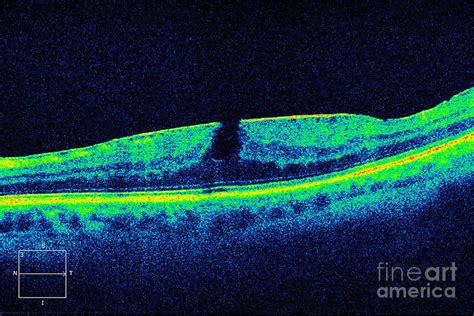 Macular Pucker With Lamellar Hole Photograph by Alan Frohlichstein ...