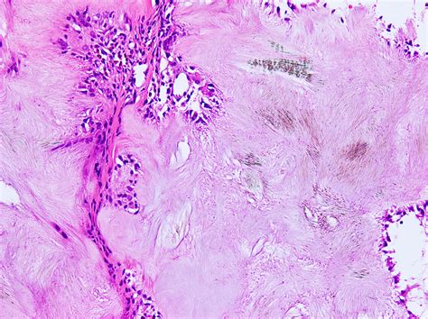 Tophus Histology