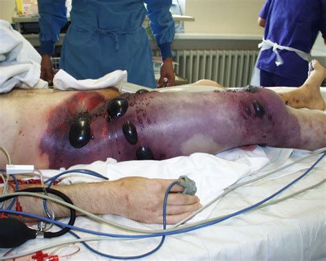 Gas gangrene - Simple English Wikipedia, the free encyclopedia