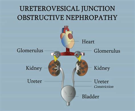 Icd 10 Batu Ureter - Berbagi Informasi