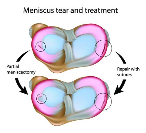 Answers to your questions about surgery to trim out a meniscus tear ...