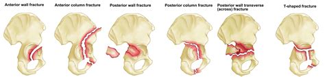 Acetabular fracture causes, symptoms, diagnosis, treatment & prognosis