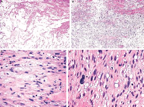 Figure 1 from Myxoid leiomyosarcoma of the uterus. | Semantic Scholar