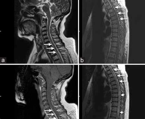 (a) Cervical spine T1-weighted MRI, (b) cervical spine T2-weighted MRI ...