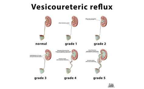 Vesicoureteric Junction Calculus Treatment | Symptoms