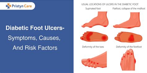 Diabetic Foot Ulcers- Symptoms, Causes, And Risk Factors - Pristyn Care