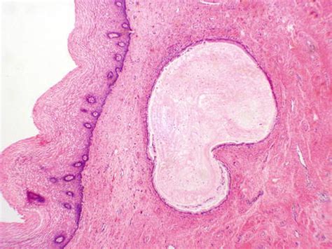 Postoperative Nodule Cervix Histology | The Best Porn Website