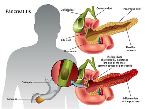 Top Homeopathic Treatment for Pancreatis In Dehradun