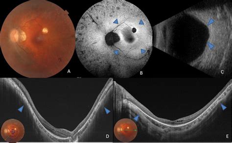 Wide macular staphyloma (patient 4, Table 1). Fundus photo with ...