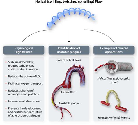 Helical flow: A means to identify unstable plaques and a new direction ...