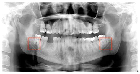 Mandibular Canal Radiograph