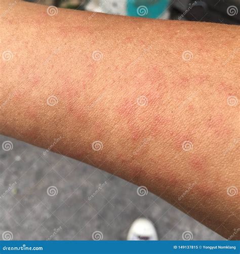 Rash Caused by Skin Allergic To Sweat, Dust and Viruses. Stock Image ...