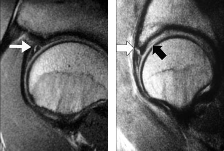 Acetabular Labral Tears - Hip Arthroscopy Australia