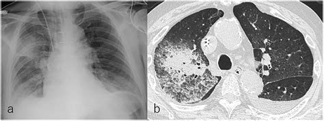 Pulmonary Edema Chest X Ray