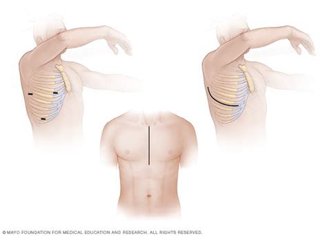 Aortic valve repair and aortic valve replacement - Mayo Clinic