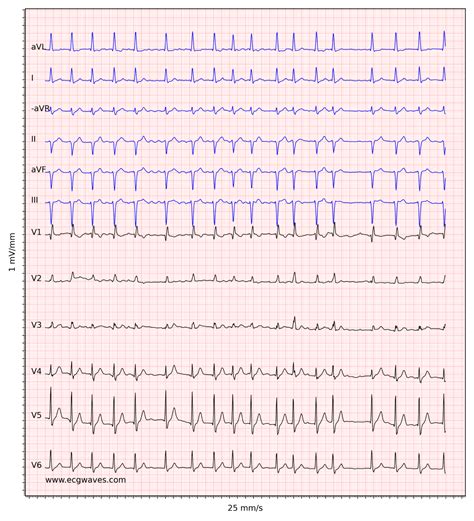 Atrial fibrillation: ECG, classification, causes, risk factors ...