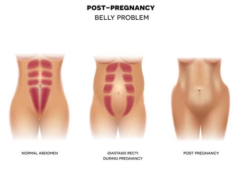 Body After Baby: What to Expect (21 Permanet & Temporary Body Changes)