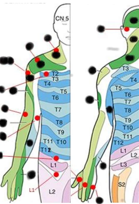 UE Dermatomes Diagram | Quizlet