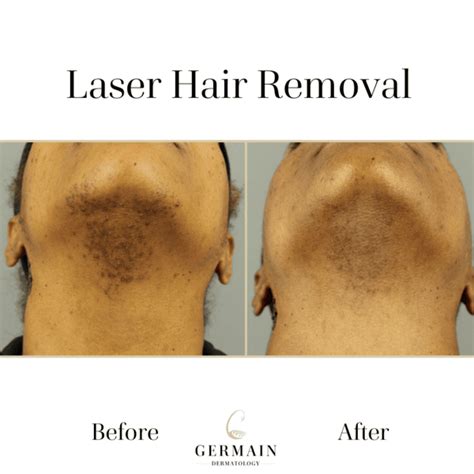 Laser Hair Removal Before & After | Mt Pleasant, Summerville