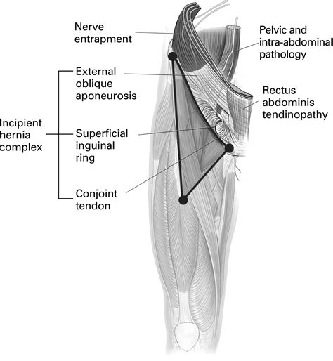 The groin triangle: a patho-anatomical approach to the diagnosis of ...