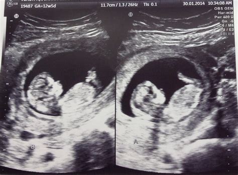 Life Shocker... Twins are on the way! | Nesting Story