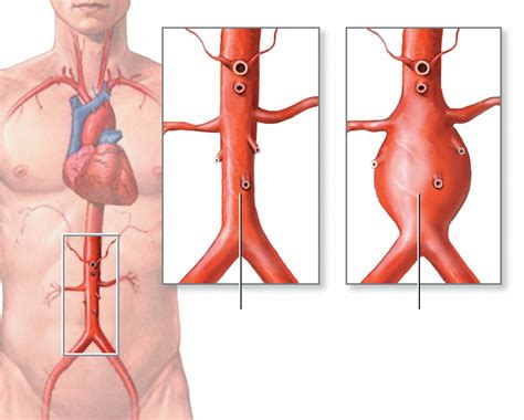 Aortic Aneurysm - Abdominal & Thoracic - Causes, Symptoms, Repair