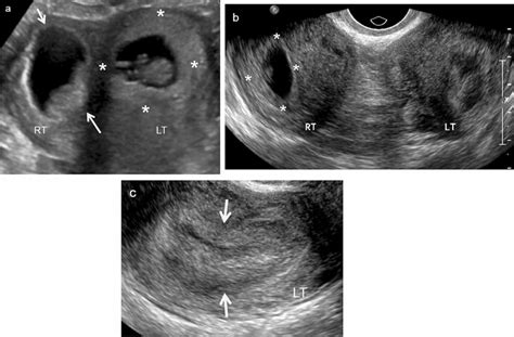 a 30-year-old woman with IUP in a septate uterus. Transverse ultrasound ...