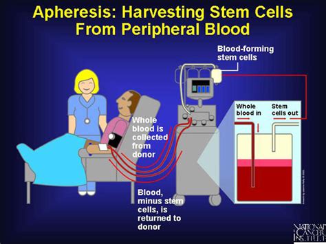 A Marrow Chronicle: Donor's Perspective part 2; Apheresis