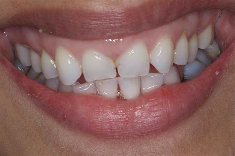 Before and After Dental Bonding Photos | Cosmetic Bonding Dentists