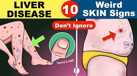 10 Skin signs of Liver Disease | Fatty liver | Cirrhosis of the Liver ...