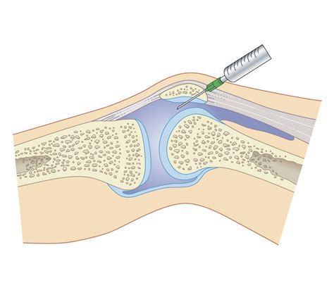 Synovial (or Joint) Fluid Analysis