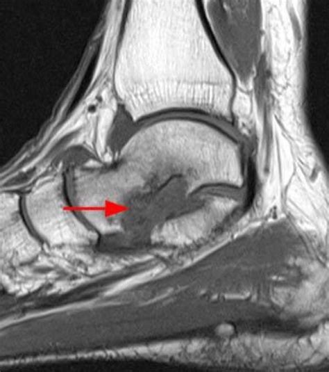 MRI NEWSLETTER: Sinus Tarsi Syndrome - Radius Imaging