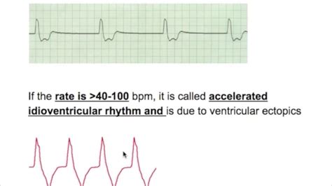 Accelerated Junctional Rhythm