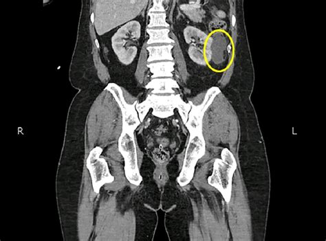 Cureus | Incidental Renal Cell Carcinoma in Pelvic Malignancies