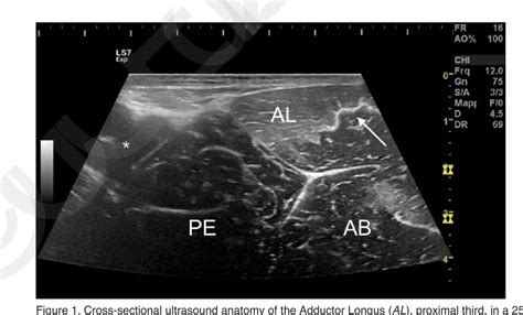 Figure 1 from Perivascular Adductor Longus muscle injury: Ultrasound ...