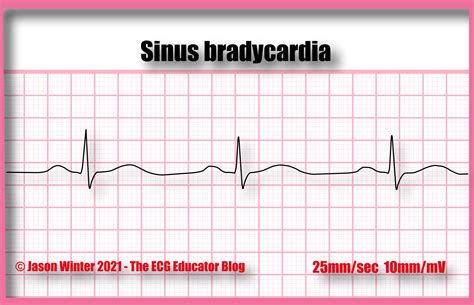 ECG Educator Blog : Sinus Bradycardia