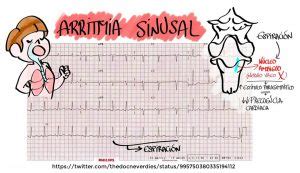 ¿Qué es la arritmia sinusal? - CampusCardio