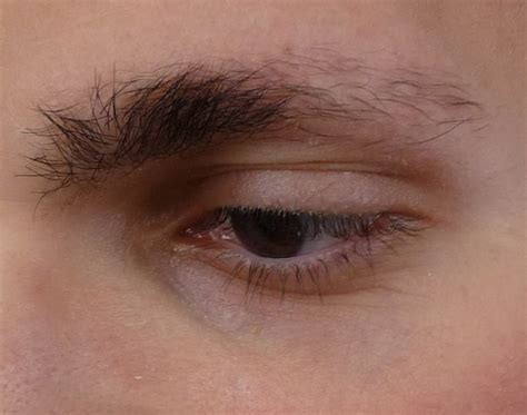 Eyebrow Transplant In Patient with Ulerythema Ophryogenes