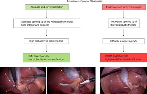 Cholecystectomy Anatomy - Anatomy Reading Source