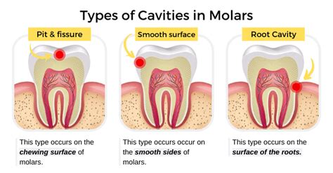 Dental Cavity Molar