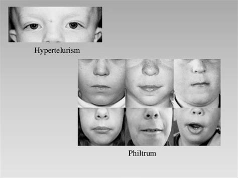 Aarskog-Scott Syndrome Archives - PT Master Guide