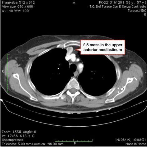 | CT scan showing a 2.5 cm mass in the upper anterior mediastinum, with ...