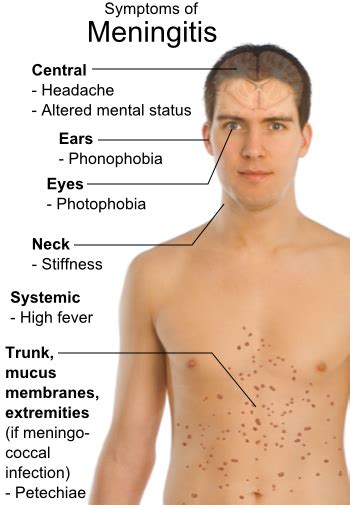 Meningococcal meningitis symptoms