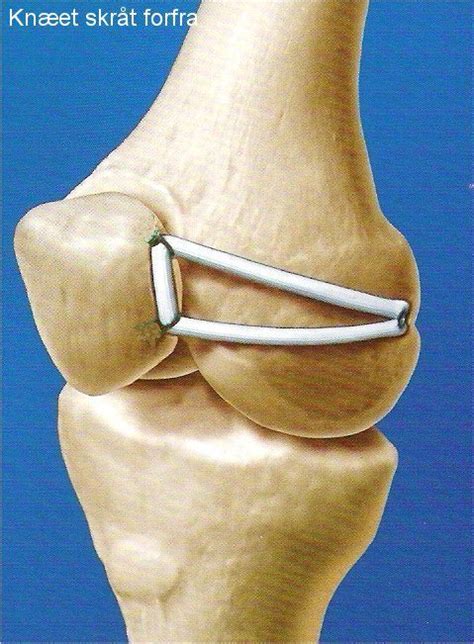 MPFL reconstruction is a reconstruction of the inner ligament that ...