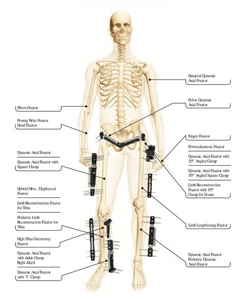 Ultimate Guide of External Fixator - Orthopromed Inc.