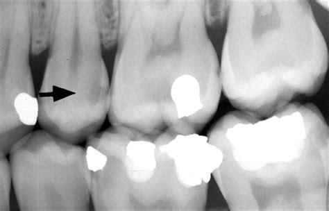 Tooth Decay XRay Picture from UI Dentistry (Hardin MD)