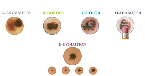 How to Tell a Mole from Melanoma - AIM at Melanoma Foundation