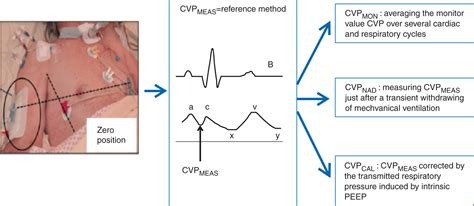 Comparison of different techniques of central venous pressure ...