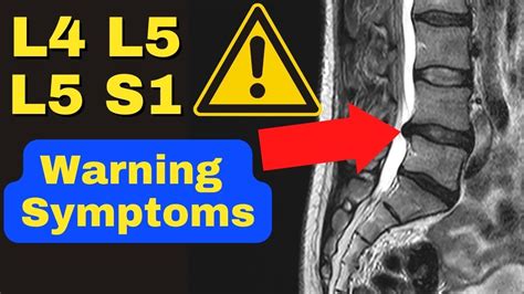 WARNING: These Are The 3 MAJOR Symptoms of a Severe L4 L5, L5 S1 Disc ...